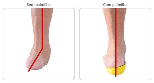 Palmilha para pé chato adquirido